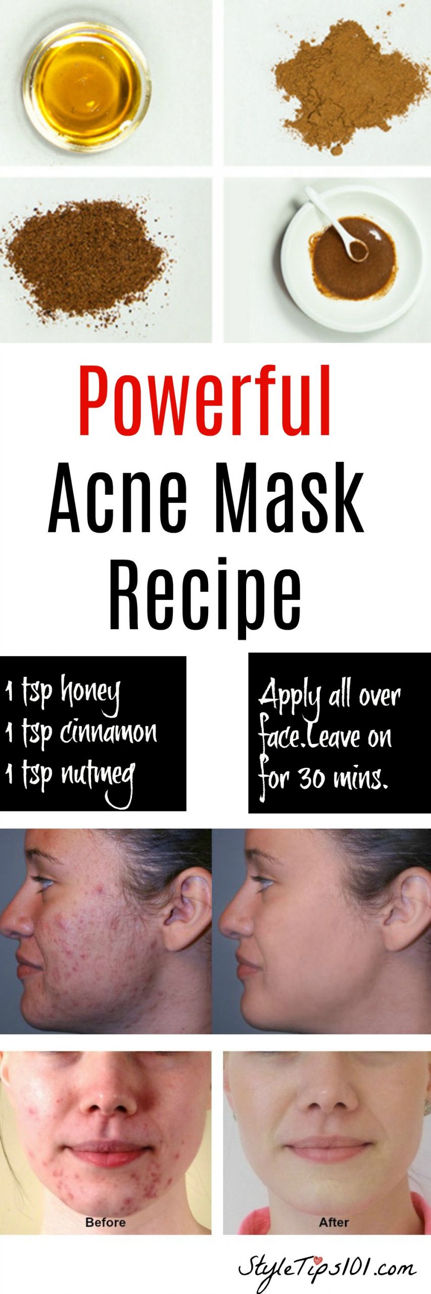 DIY Face Masks Acne
 Homemade Natural Acne Mask