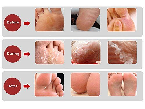 Diy Baby Foot Peel
 Foot Peel to remove calluses rought skin and dry feet