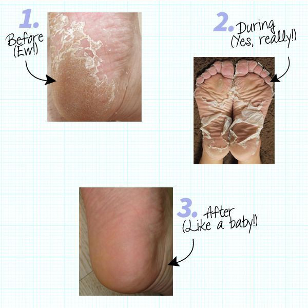 Diy Baby Foot Peel
 DS exclusive DIY natural skincare kits