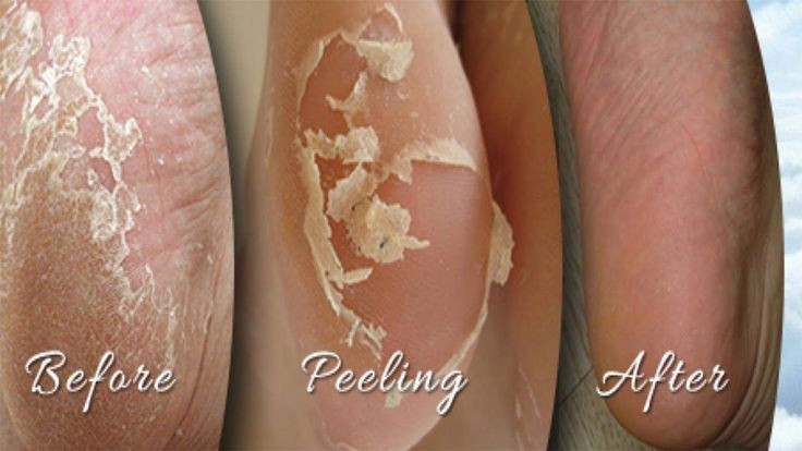Diy Baby Foot Peel
 Home Reme s For Peeling Skin Your Feet TOP 5 DIY