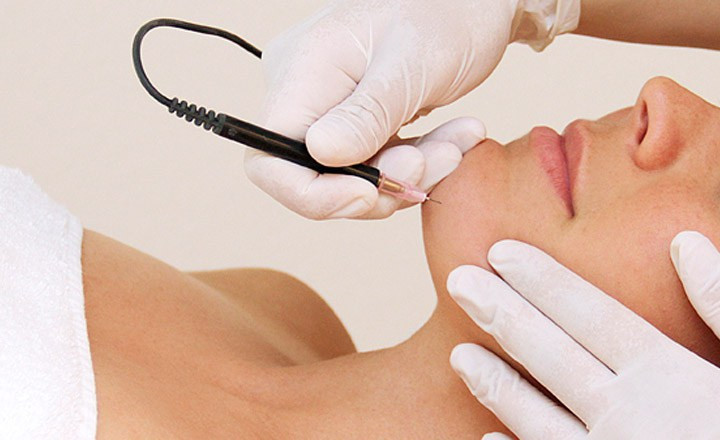 DIY Electrolysis Hair Removal
 When It es To Hair Removal Laser Can Be A Viable