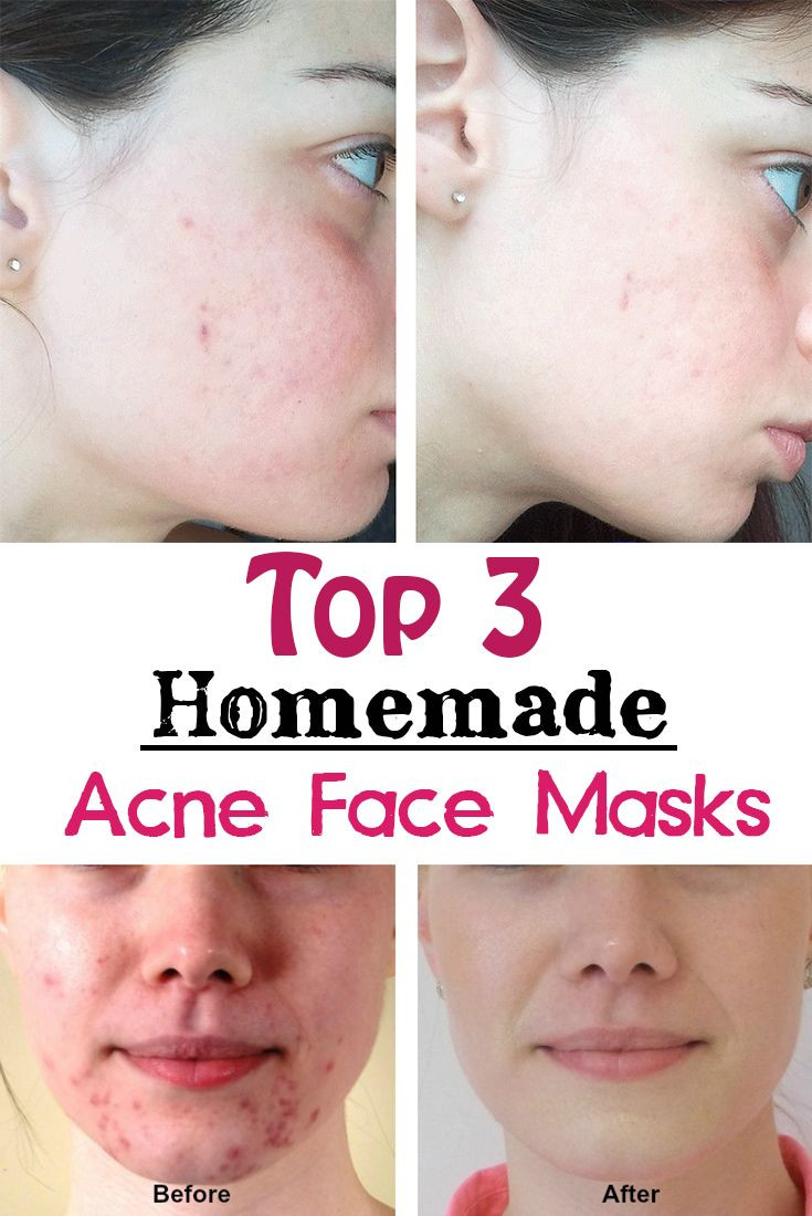 DIY Face Masks Acne
 Top 3 Homemade Acne Face Masks