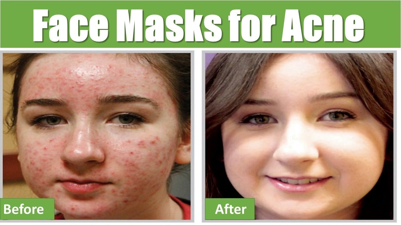 DIY Face Masks Acne
 Easy DIY Homemade Natural Face Masks for Acne