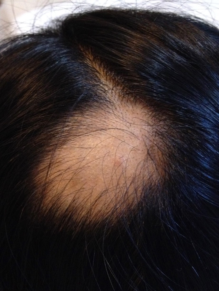 Hair Loss In Children Due To Stress
 My Journey in Electronic Ink My Hair Loss Treatment