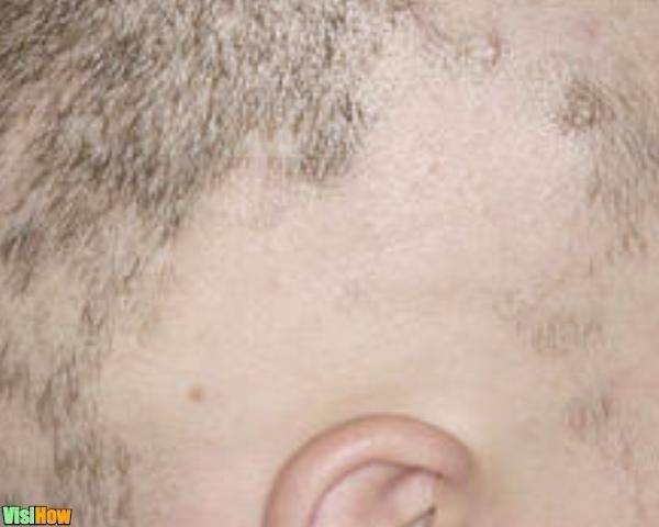 Hair Loss In Children Due To Stress
 Stop Childhood Hair Loss Due to Tinea Capitis vs Alopecia