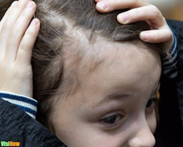 Hair Loss In Children Due To Stress
 Stop Childhood Hair Loss Due to Tinea Capitis vs Alopecia