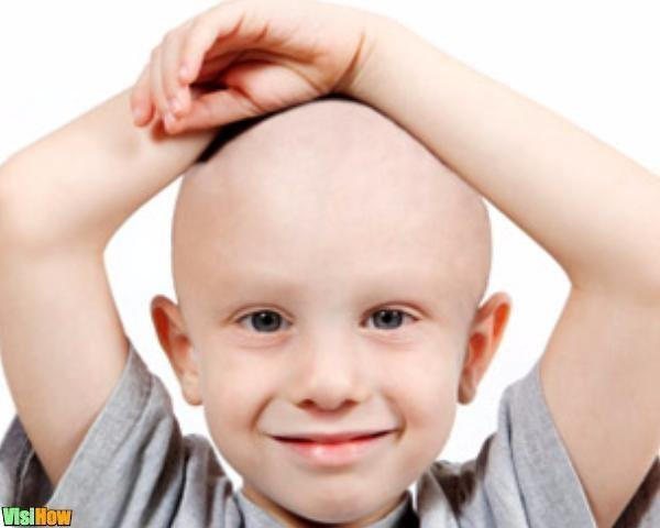 Hair Loss In Children Due To Stress
 Stop Childhood Hair Loss Due to Tinea Capitis vs Alopecia